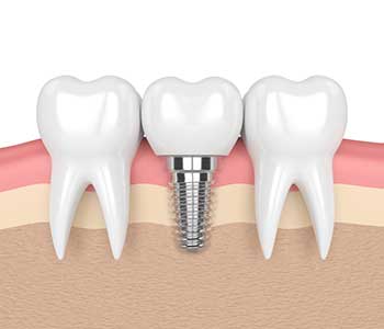 How long will a dental implant last - All About Costa Mesa CA Implants Treatment
