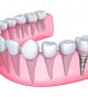 High-quality Dental Implants Offered at Dentist’s Office in Costa Mesa