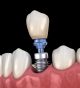 Resolve Early Tooth Loss Issues with Dental Implant Prosthetics