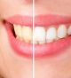 Give Your Dull Smile a Dazzling New Look with KöR Teeth Whitening