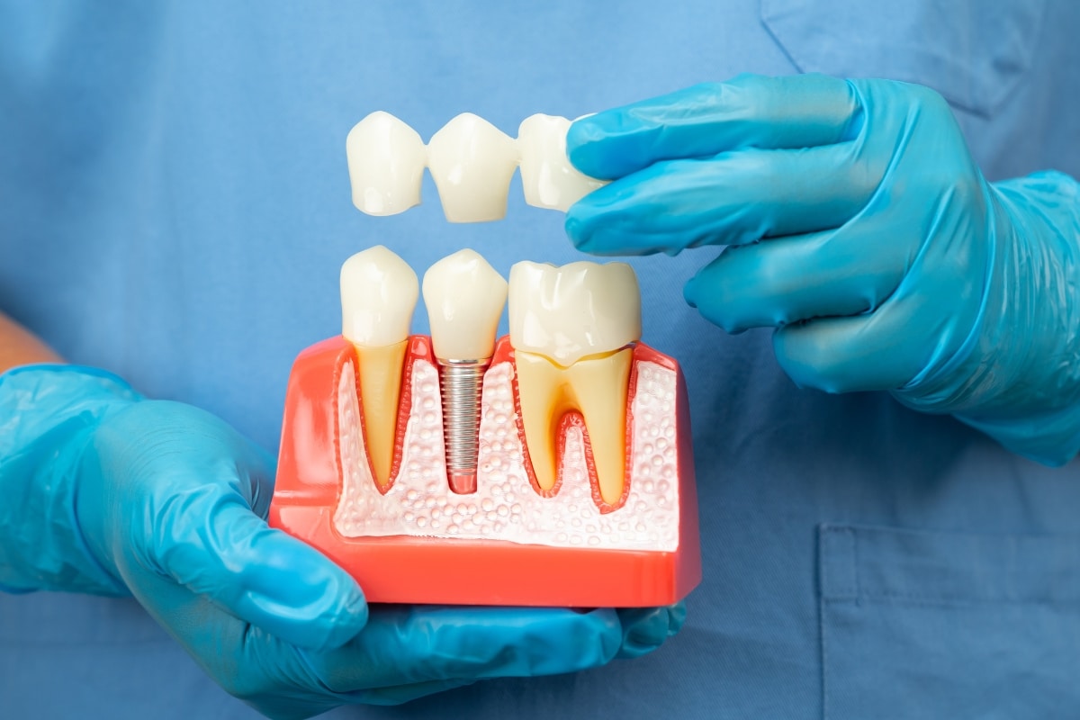 Dentist holding dental implant model with bridge for age group benefits