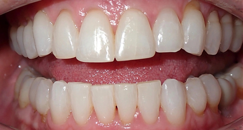 img aligned front teeth smile after