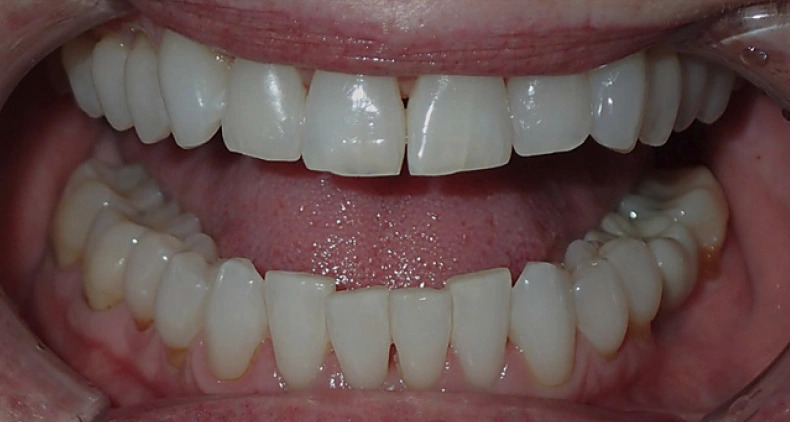 img aligned front teeth smile before