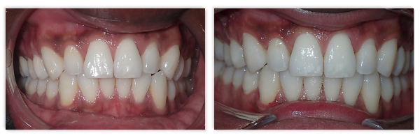 Invisalign 3