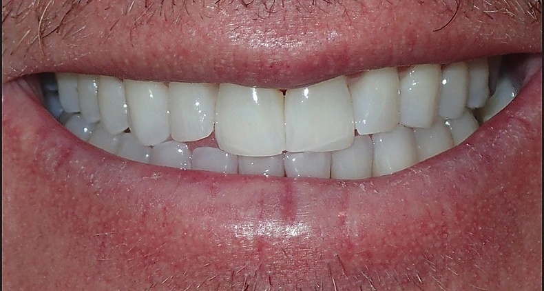 img bright white dental smile after
