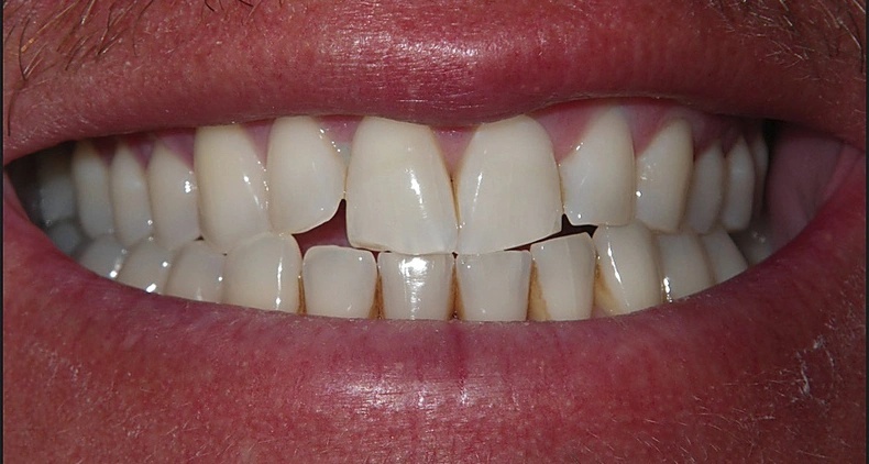 img bright white dental smile before