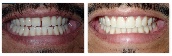 Invisalign 4