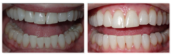 Invisalign 5
