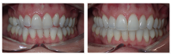 Invisalign 6