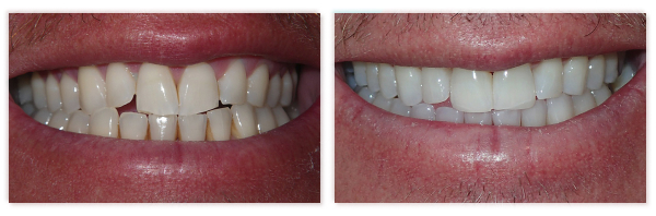 Invisalign 6
