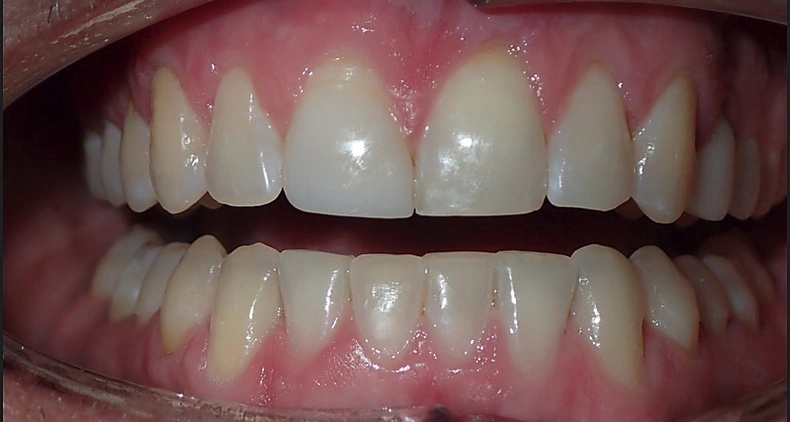 img healthy gum and teeth smile after