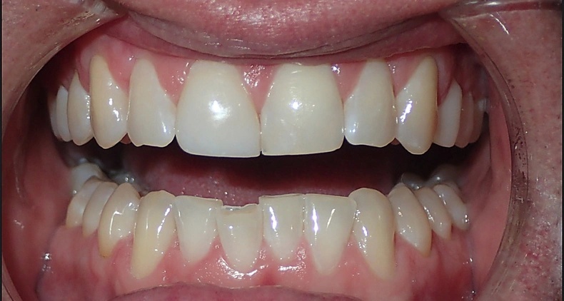 img healthy gum and teeth smile before