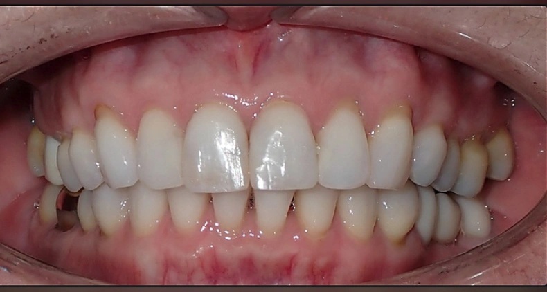 img healthy teeth and gums after