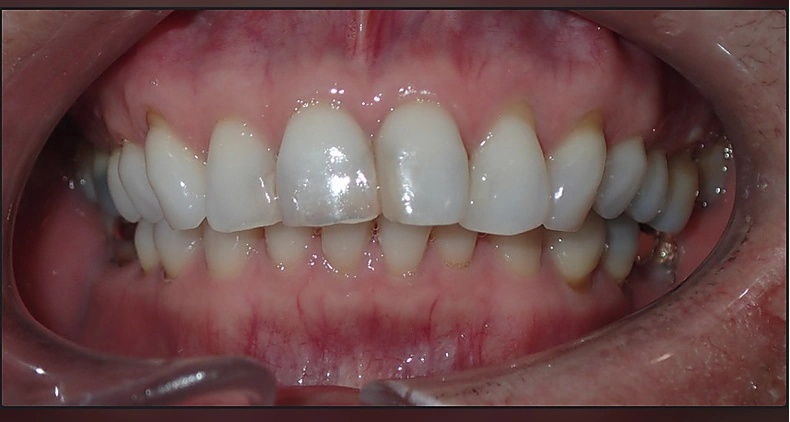 img healthy teeth and gums before
