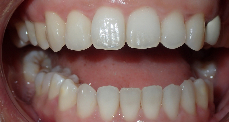 img invisalign after