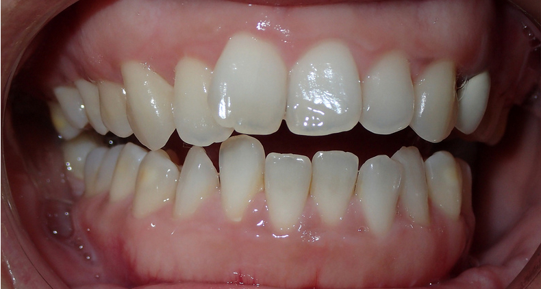 img invisalign before