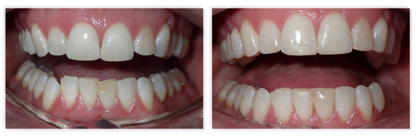 Invisalign 7