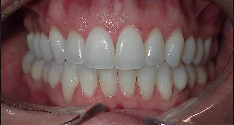 img straight white teeth smile after
