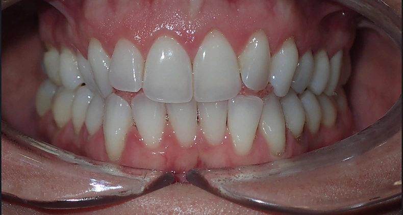 img straight white teeth smile before