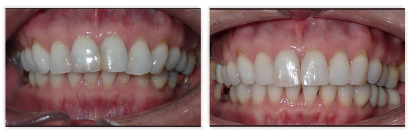 Invisalign 8