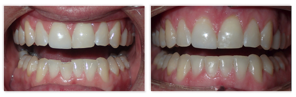 Invisalign 9