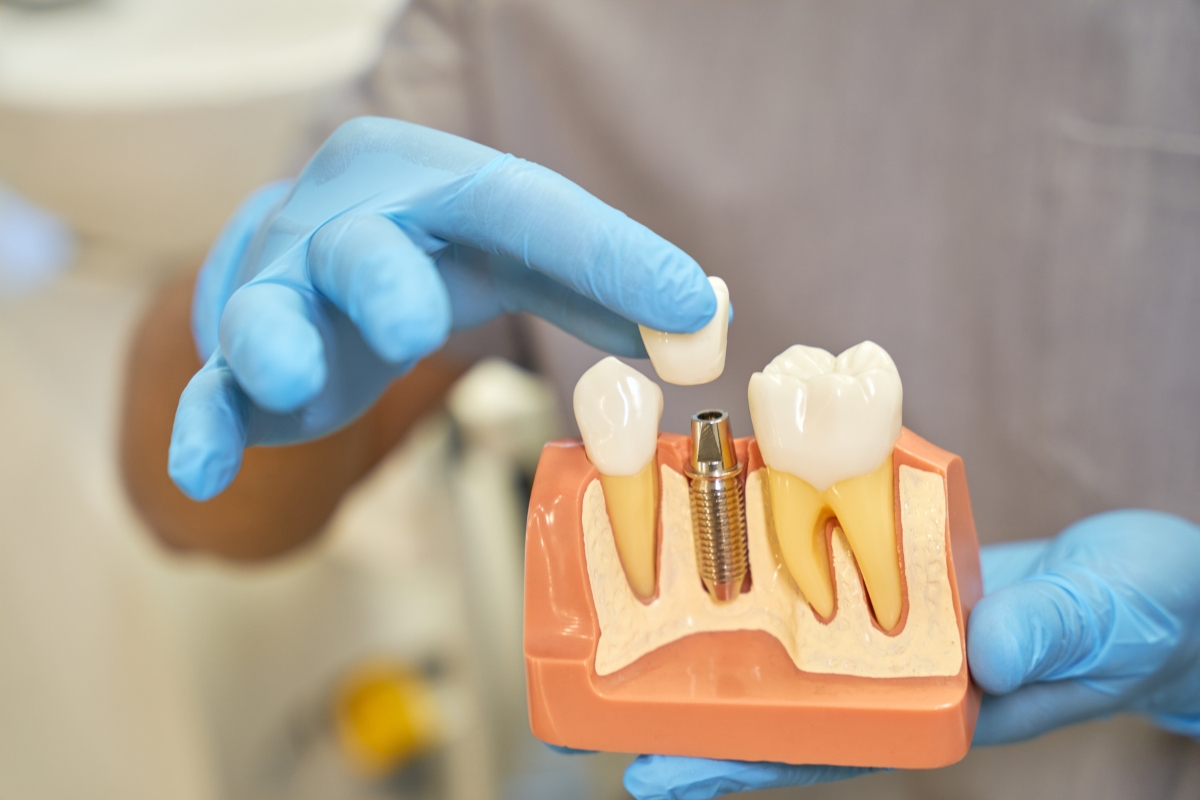 How Long Do Dental Implants Last With Proper Oral Care?